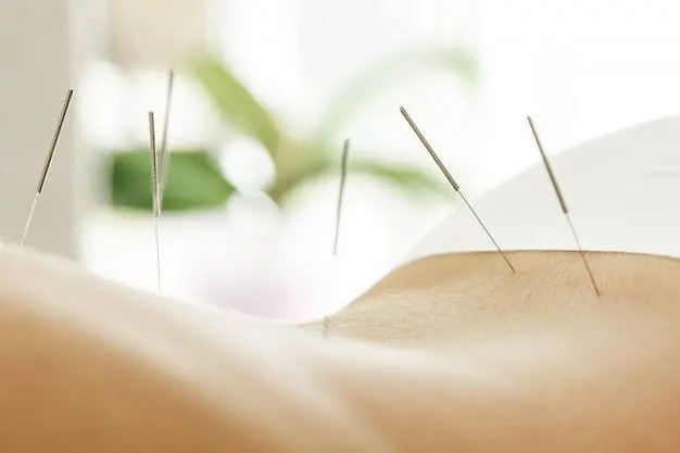 can acupuncture treat pain