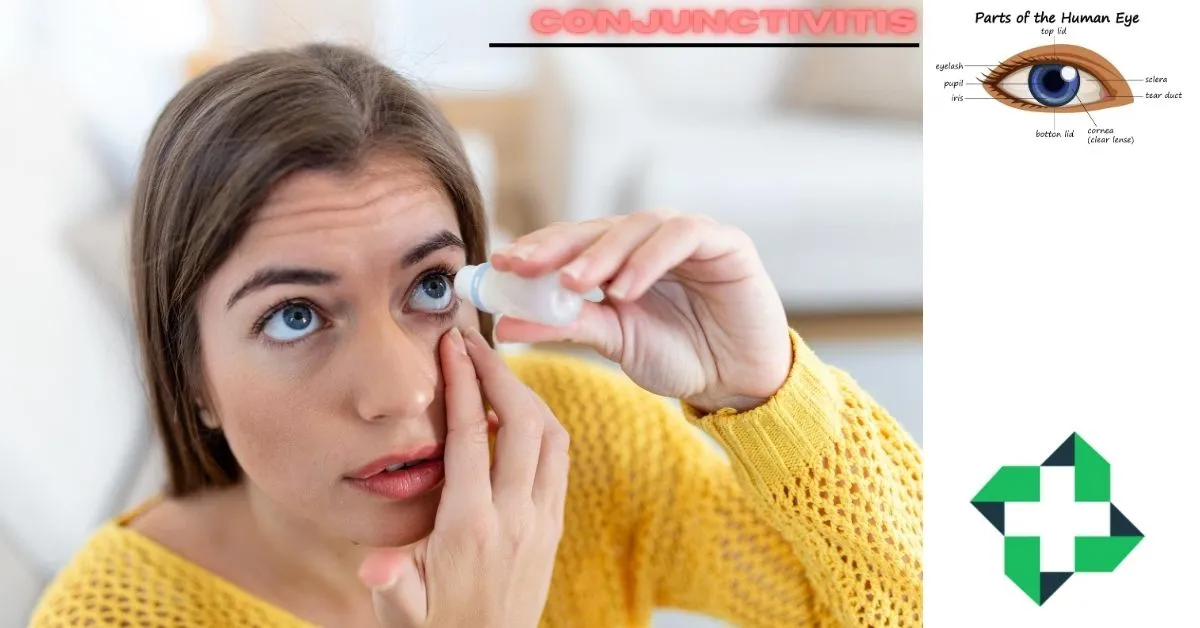 Best treatment for conjunctivitis types cause