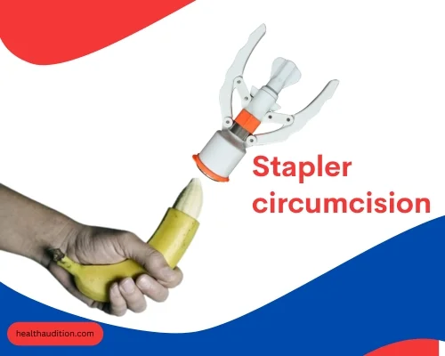 stapler circumcision