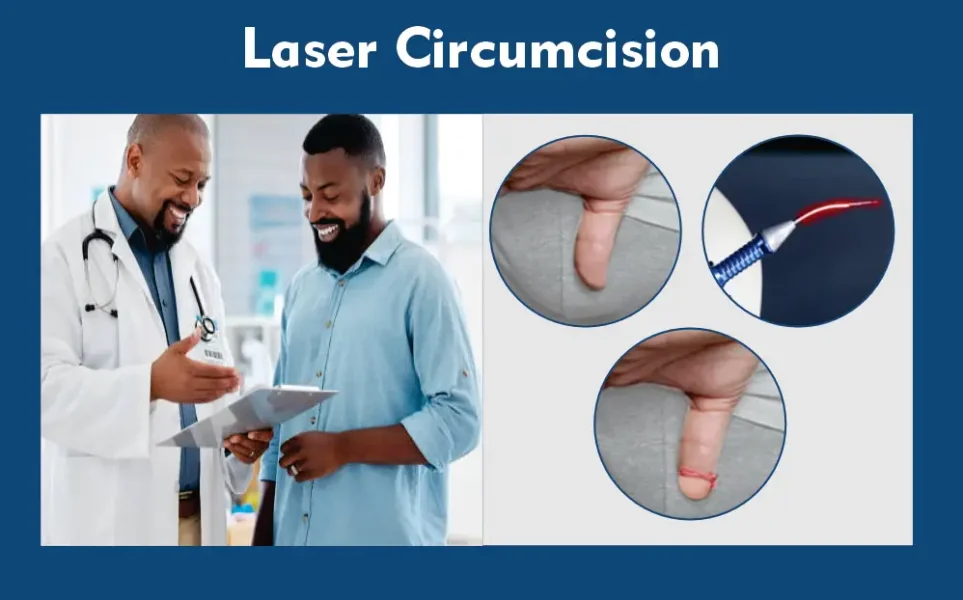 laser circumcision