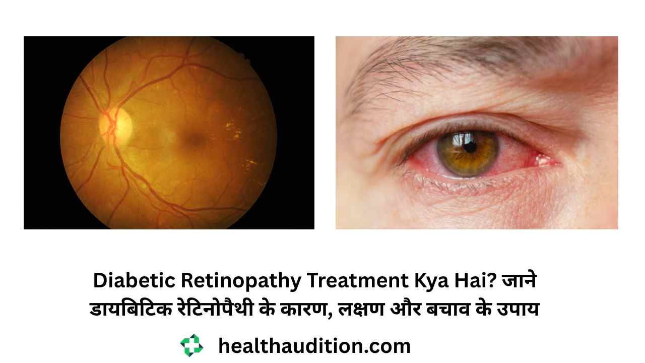 Diabetic Retinopathy Treatment Kya Hai